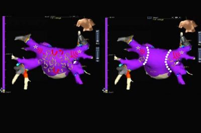 κατάλυση ablation κολπικής μαρμαρυγής