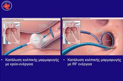 Cryo-balloon RF Ablation