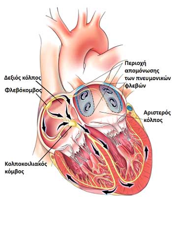 H κατάλυση (ablation) της κολπικής μαρμαρυγής είναι μία ελάχιστα επεμβατική θεραπεία χρησιμοποιείται για την αντιμετώπιση της κολπικής μαρμαρυγής.