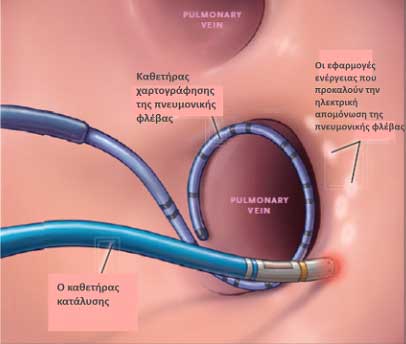 RF ablation