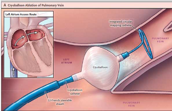 κατάλυση με μπαλόνι κρυο-ενέργειας (Cryo-balloon ablation)